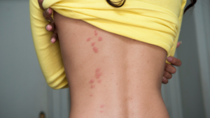 Bed bug bites