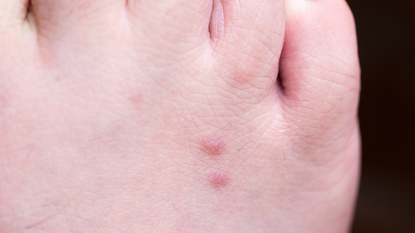 Flea bite