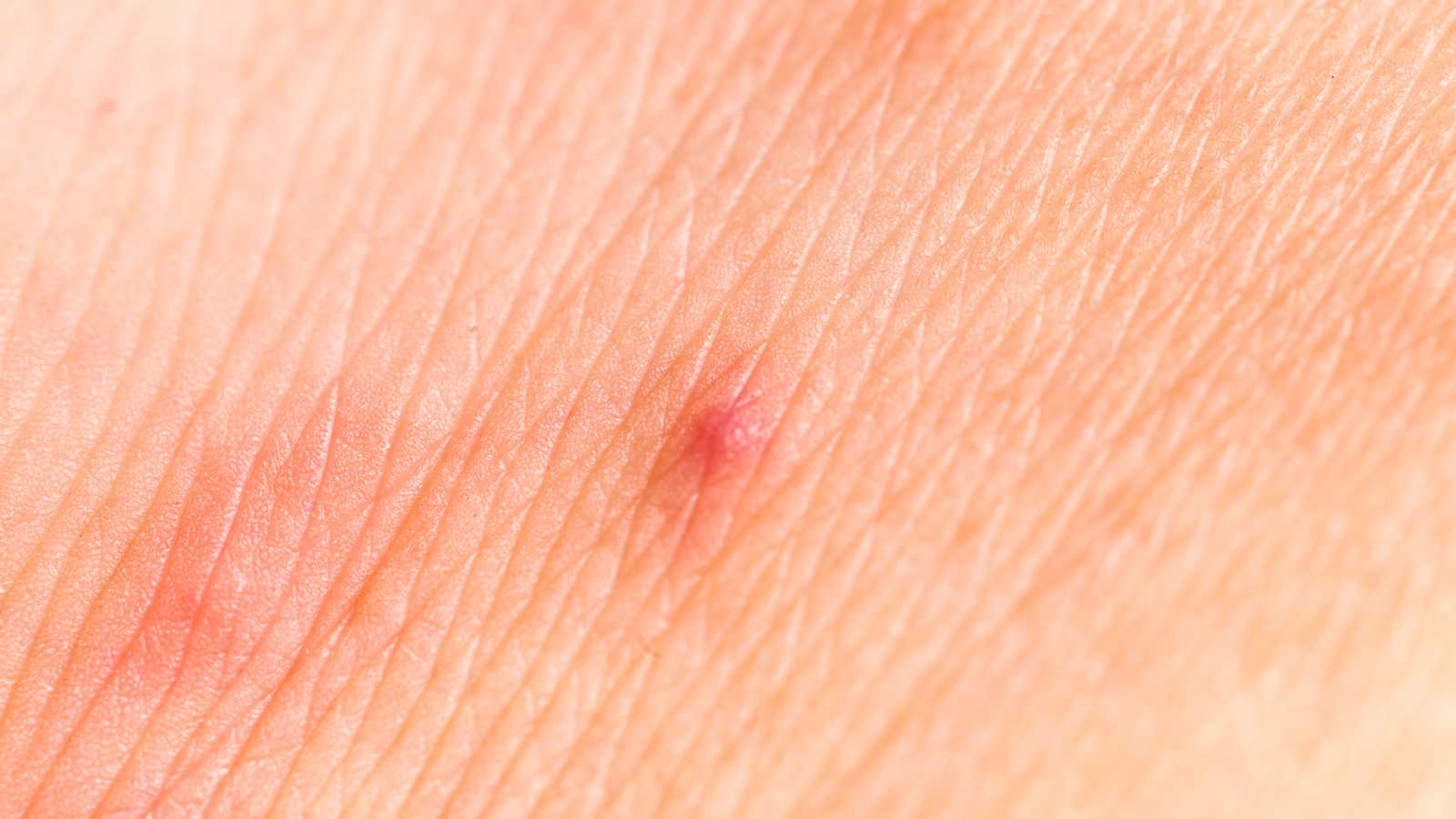 Flea bites on human