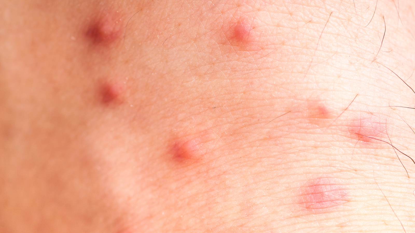 Flea bites
