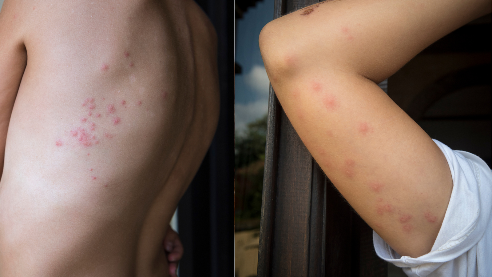Photos of bed bug bites