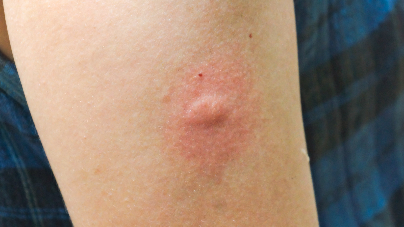 Photo of mosquito bite
