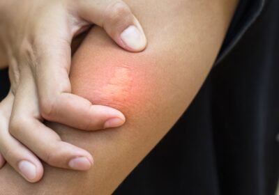 Bitės įkandimas – paraudusi ir patinusi oda ant rankos