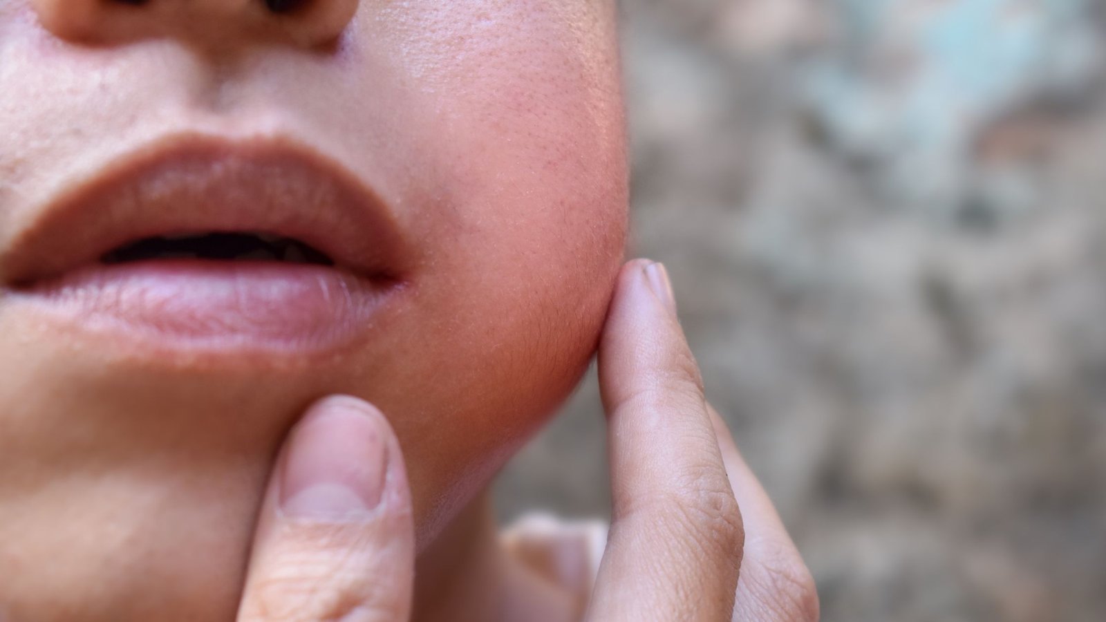 Stiprus patinimas veido srityje po bitės, vapsvos arba širšės įgėlimo – vienas iš alergijos simptomų
